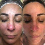 Before and After Sensitive Skin