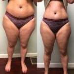 Before and After Body Lymphatic Massage and Radiofrequency treatment