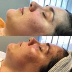 Before and After Dermaplaning Facial