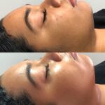 Before and After Dermaplaning Facial
