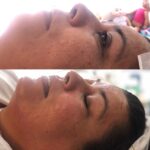 Before and After Facial