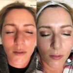 Before and After Microcurrent treatments