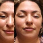 Before and After Dermaplaning Facial with Microcurrent