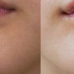 Teen Facial